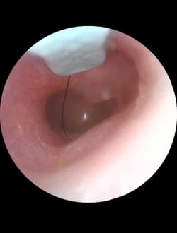 dog hair stuck behind ear is driving me crazy with ringing in the ear