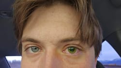 My eye changed color after surgery